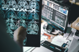 Donanemab. Nowy lek spowalnia postęp choroby Alzheimera…