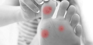 Kurzajki – częsty problem dermatologiczny