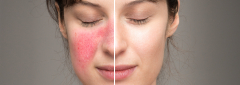 Kwas azelainowy w leczeniu schorzeń dermatologicznych