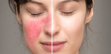 Kwas azelainowy w leczeniu schorzeń dermatologicznych