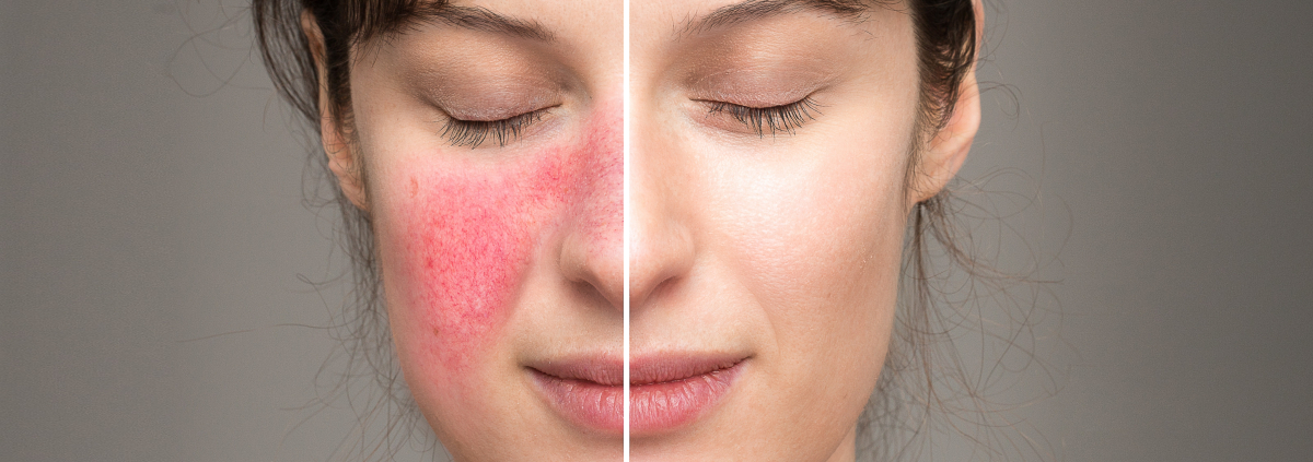 Kwas azelainowy w leczeniu schorzeń dermatologicznych (fot. shutterstock.com)