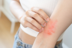 Alergia może przyjmować różne postacie – jakie leki warto wówczas zastosować?