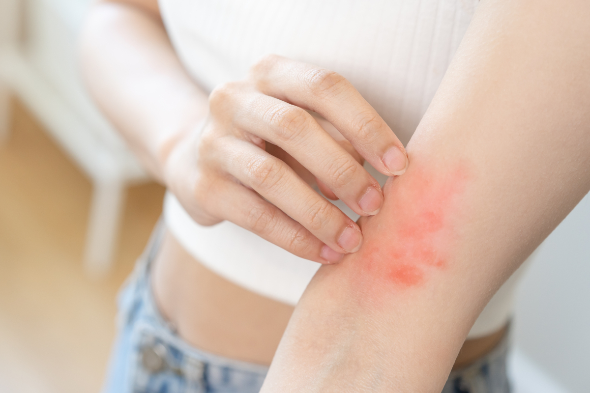 Alergia może przyjmować różne postacie - jakie leki warto wówczas zastosować? (fot. shutterstock.com)