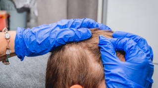 Narasta problem wszawicy. Profilaktyka i leczenie wymagają edukacji