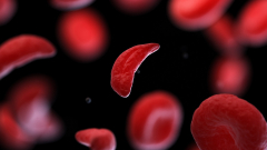 Anemia sierpowata wyleczona? Naukowcy o sukcesie nowej terapii….