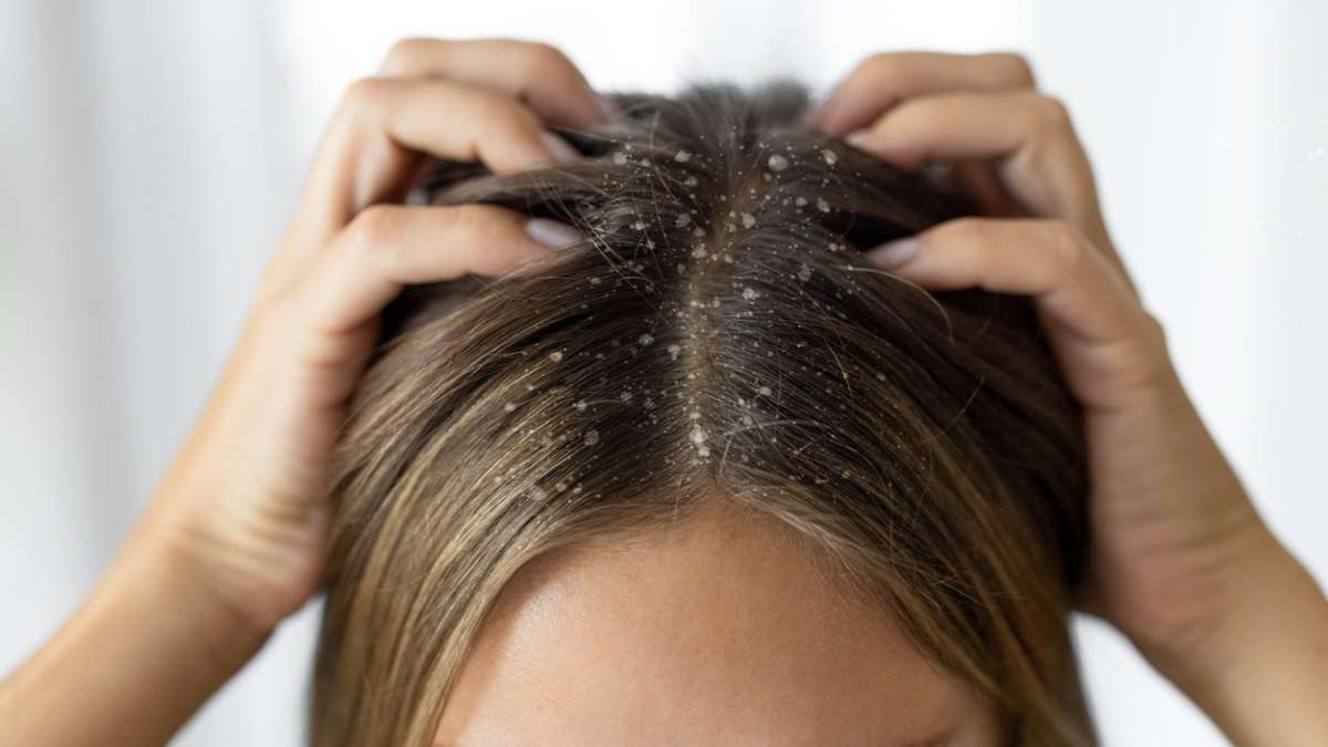 Łupież pod kontrolą. Rola farmaceuty w skutecznej terapii (fot. istockphoto.com)