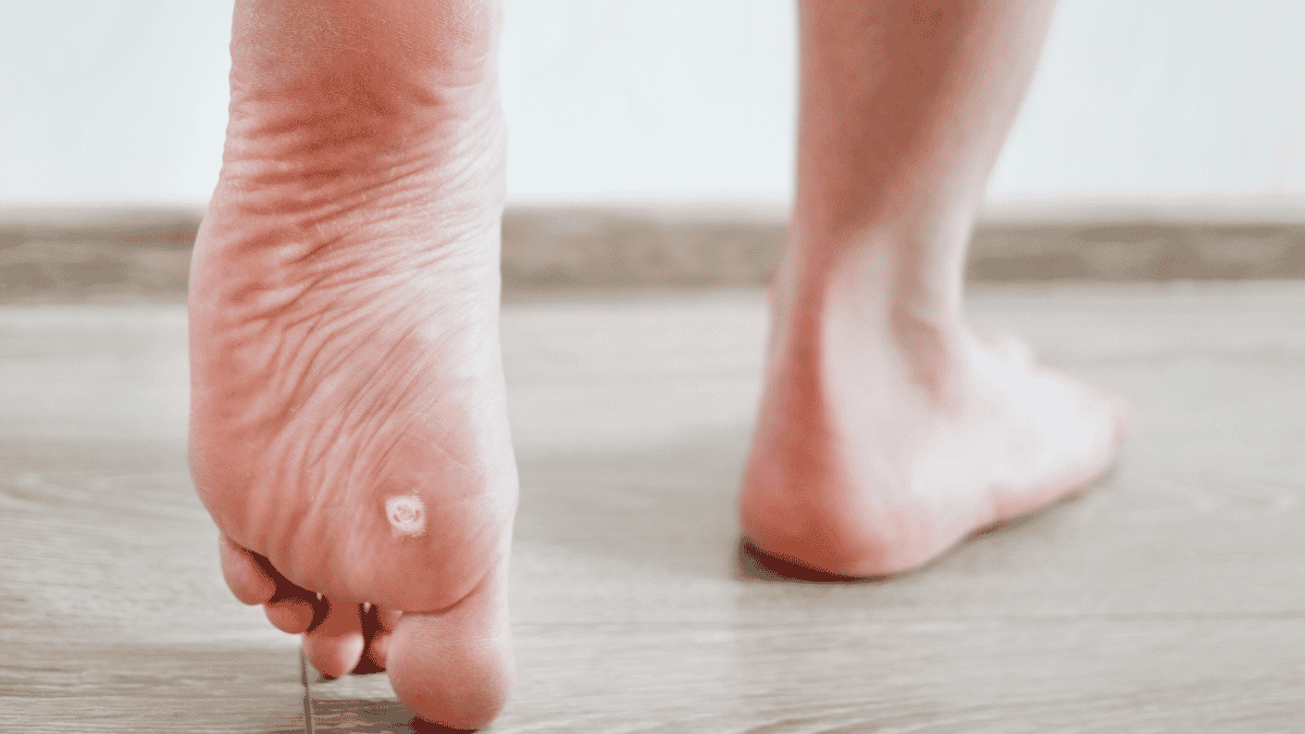 Brodawka podeszwowa na pięcie (fot. istockphoto.com)